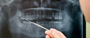 Occlusal Splints