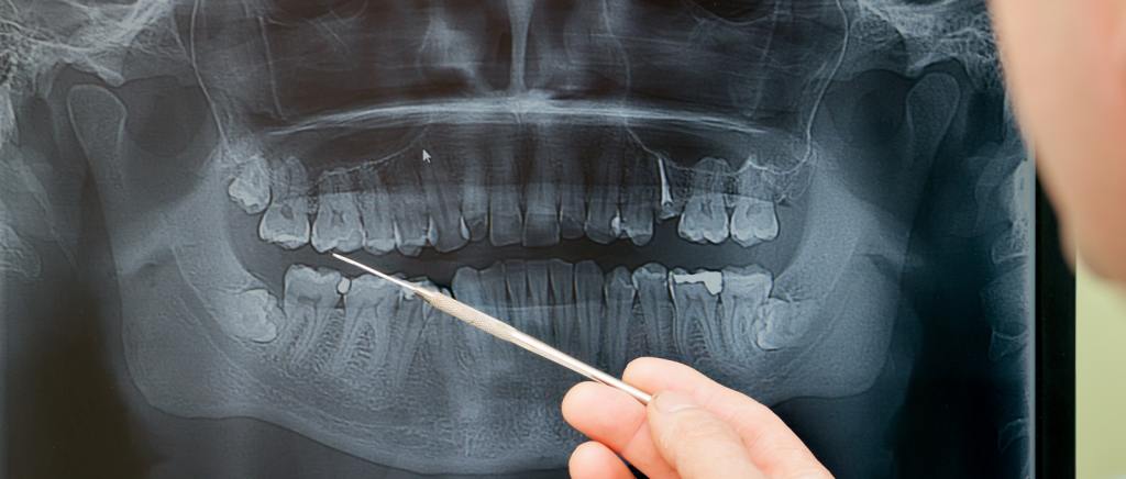 Digital X-Rays