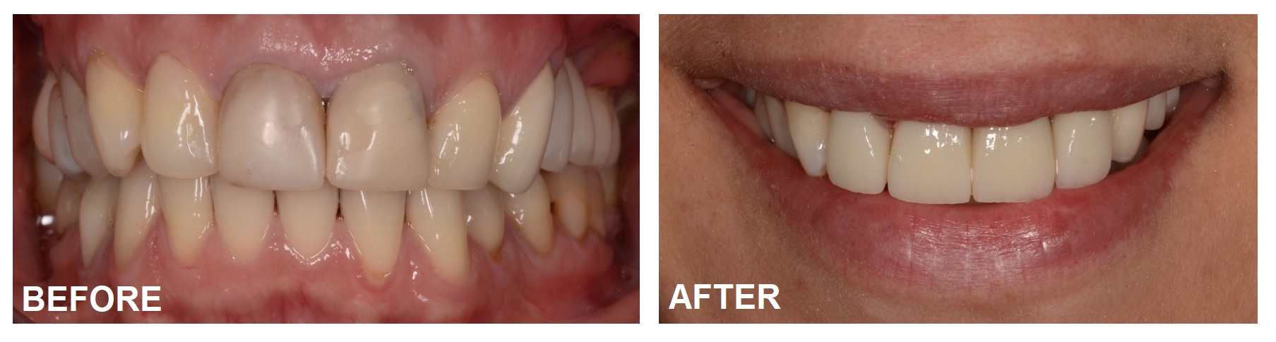 BA-veneers